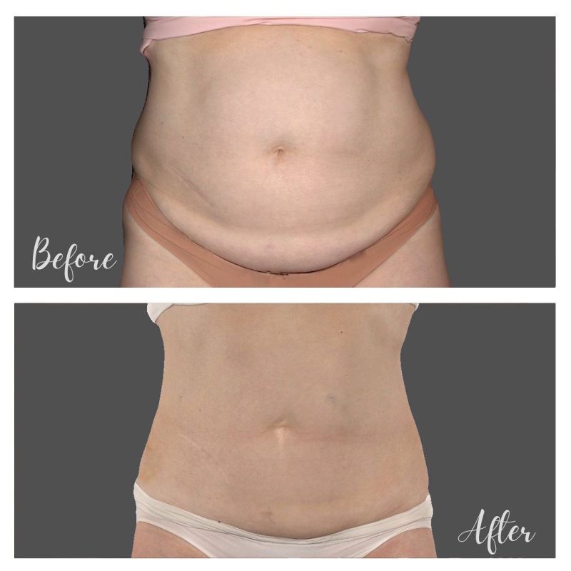 Coolsculptin and Evolvex results
